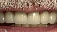 Dental Crowns