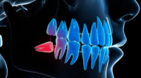 Wisdom Teeth Removal