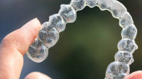 Invisalign
