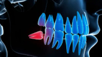 Wisdom Tooth Extraction