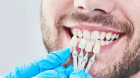 Porcelain Veneers