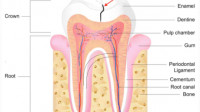 Cracked Tooth Repair