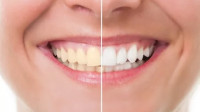 Teeth Whitening