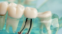 Emergency Root Canals