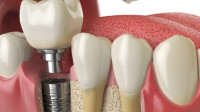 Dental Implants