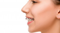 Overbite Treatment