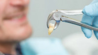 Emergency Extractions