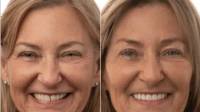 Zygomatic Dental Implants