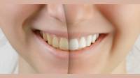 Tooth Whitening