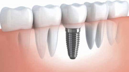 Dental Implant